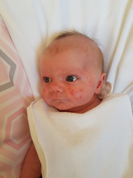 Baby's skin :( pic included