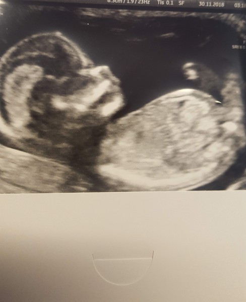 Pregnancy after loss: spring 2019 edition (The Brexit Babes) 🐧 Part 2