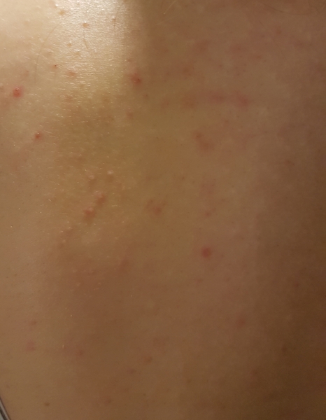 *Pic included* sudden acne / rash on torso, spread to legs and neck