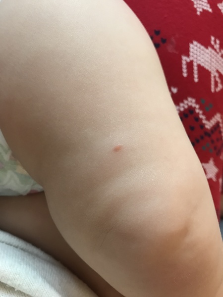 Mark on baby's leg