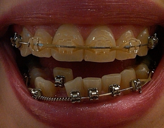 Invisible braces