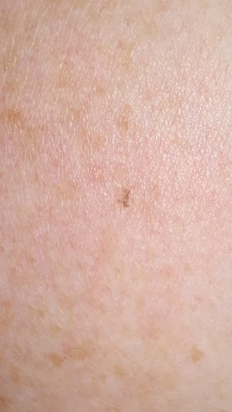 To ask if this could be melanoma?