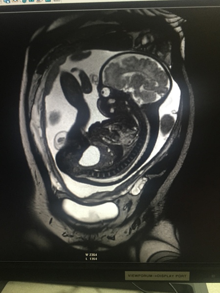 Can a sonographer accurately tell the sex in 2/3 seconds?