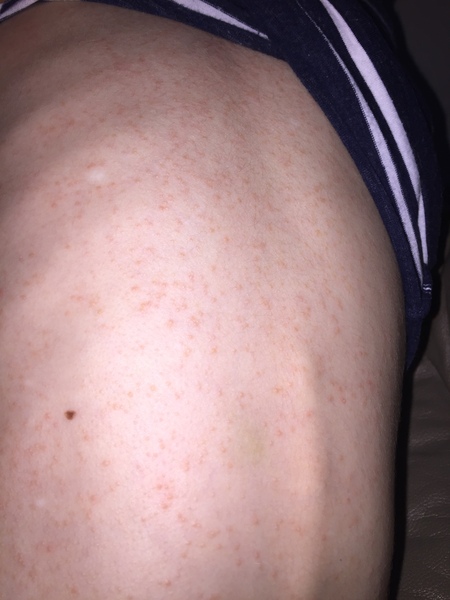 Help with this rash please