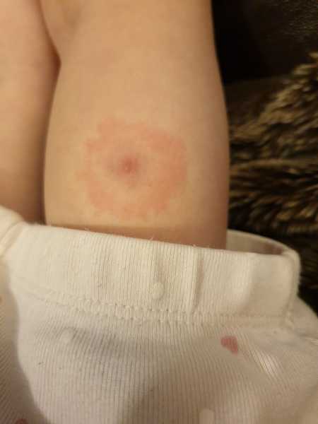 To think this could be lymes disease