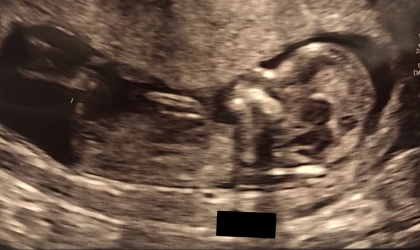 June 2019 Thread 4 - sliding towards 2nd trimester