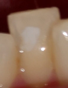 Tooth whitening, what is this white mark?😫help anyone