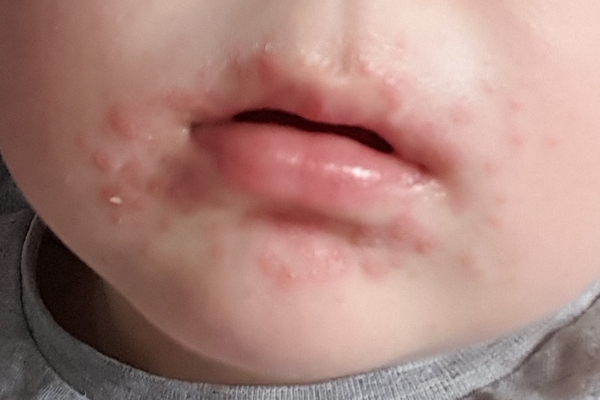 Is this hand foot and mouth? (Pic)