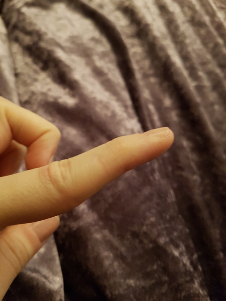Has anyone sliced/damaged the ligament in their finger? ***WARNING potentially gross picture inside***