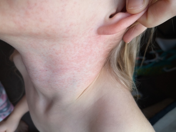 Rash on child's face ?!