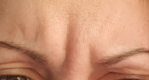 Botox diary
