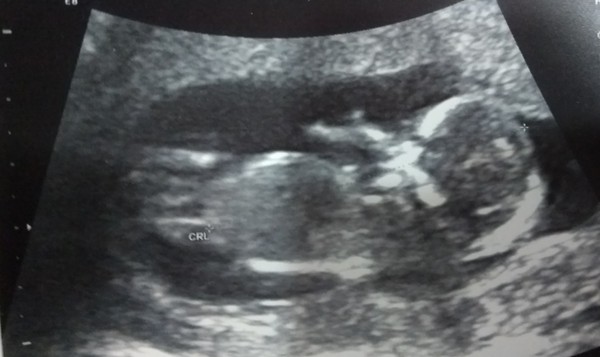 June 2019 Thread 4 - sliding towards 2nd trimester