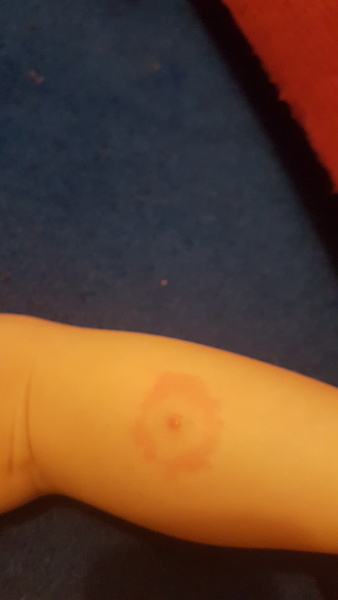 To think this could be lymes disease