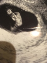 7 week scan