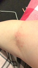 Scabies? (Photos - not graphic)