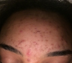 Someone please help me fix my terrible skin!