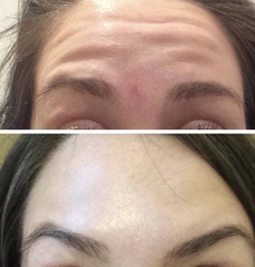 AIBU to consider botox at the age of 27? (See photos)