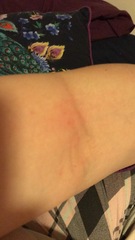 Scabies? (Photos - not graphic)