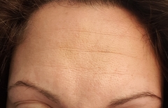 Botox diary