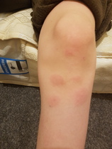 My son keeps getting theses bites?