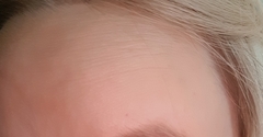 AIBU to consider botox at the age of 27? (See photos)