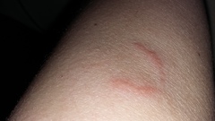 What's this rash (with tiny blisters-pics)