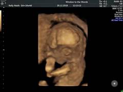 First baby due June 2019!