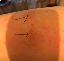 Being bitten