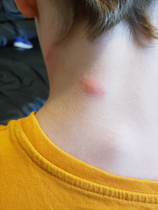 My son keeps getting theses bites?