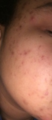 Someone please help me fix my terrible skin!