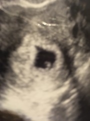 7 week scan