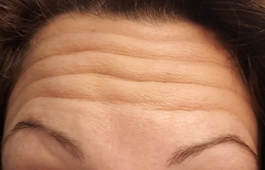 Botox diary