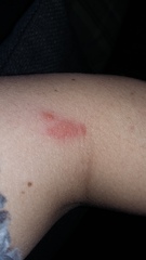 What's this rash (with tiny blisters-pics)
