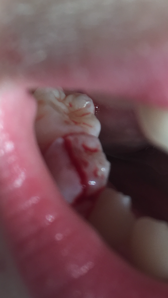 10 year cracked tooth - what to do?