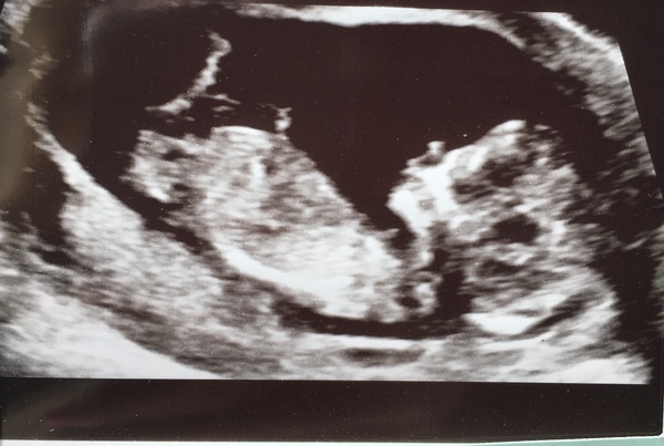 August 2019 4: All the scans and hopefully the end of nausea