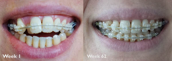 To ask if anyone has done Invisalign or other adult braces?