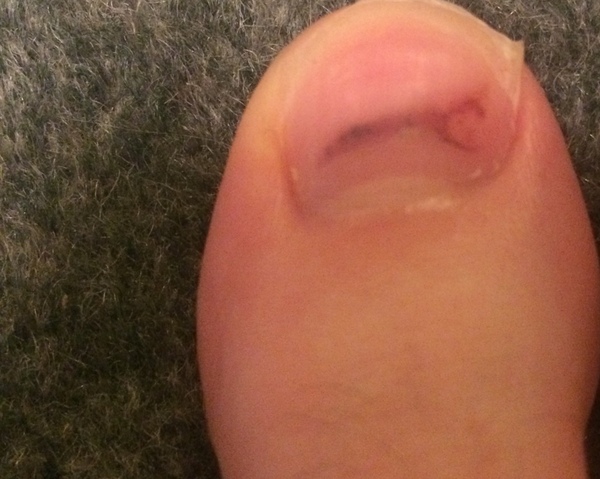 To worry I might have nail cancer?