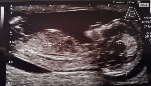 Guess baby's sex!