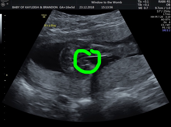 16+5 gender scan confused