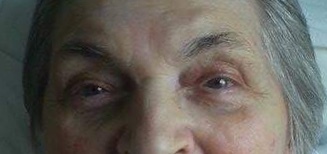 Black circles/hollows - anyone got a magic remedy?