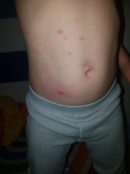 Will my DS still feel unwell once chickenpox rash develops?