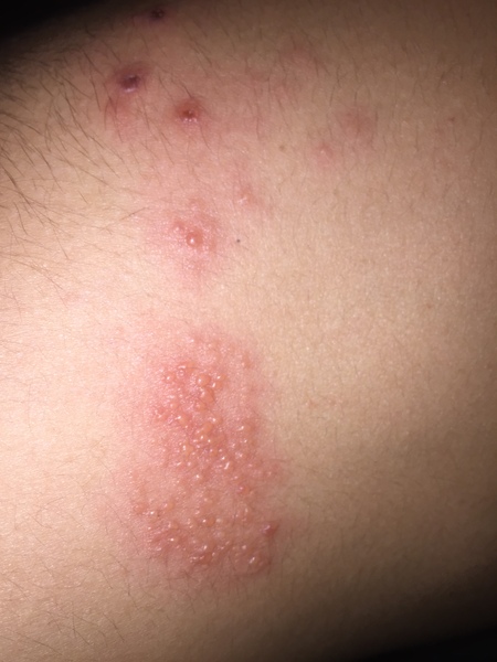 Is this shingles? (Photo)
