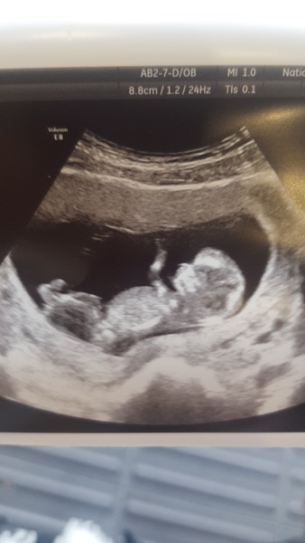 August 2019 Part 3: nausea, scans and big reveals