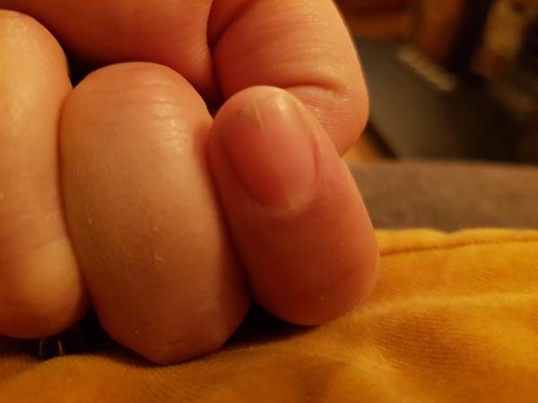 Split Nail Help...any experts about?
