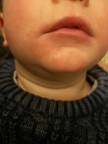 Possible allergy rash