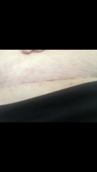 Csection yesterday - daren't move.  Tips please!