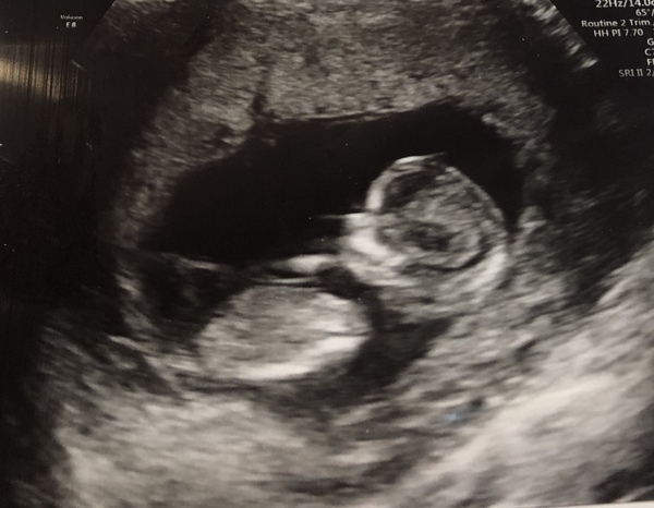August 2019 4: All the scans and hopefully the end of nausea
