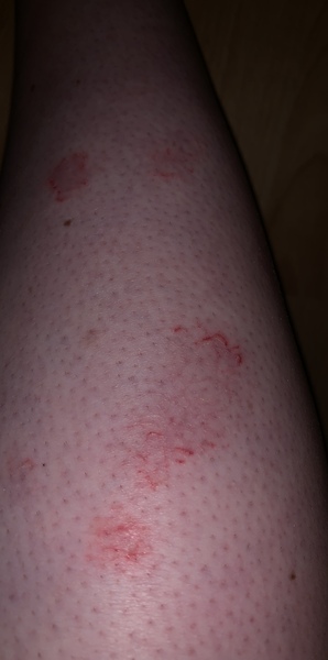 Help. Is this psoriasis?