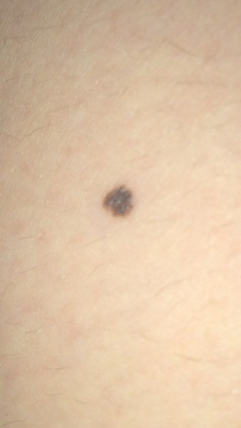 Pretty sure I have a melanoma (skin cancer)