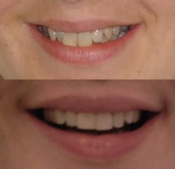To ask if anyone has done Invisalign or other adult braces?